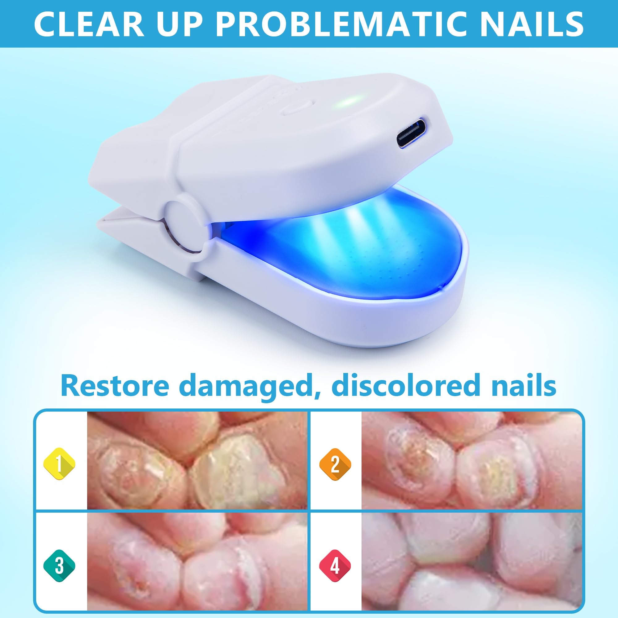 Toelight Nail Light Therapy by Tilcare - Fungal Nail Laser with